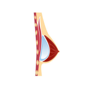 Subfascial